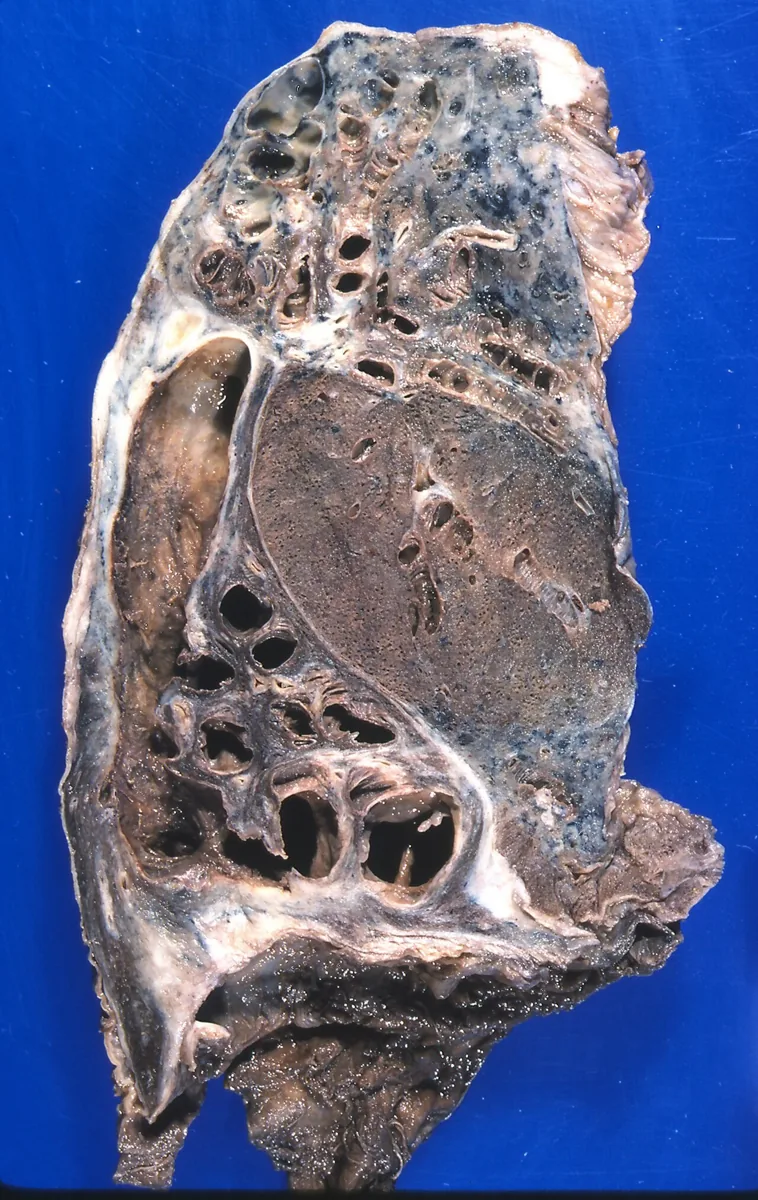 Bronchiectasis – Gross specimen: lung with markedly dilated, saccular bronchi and surrounding scarring