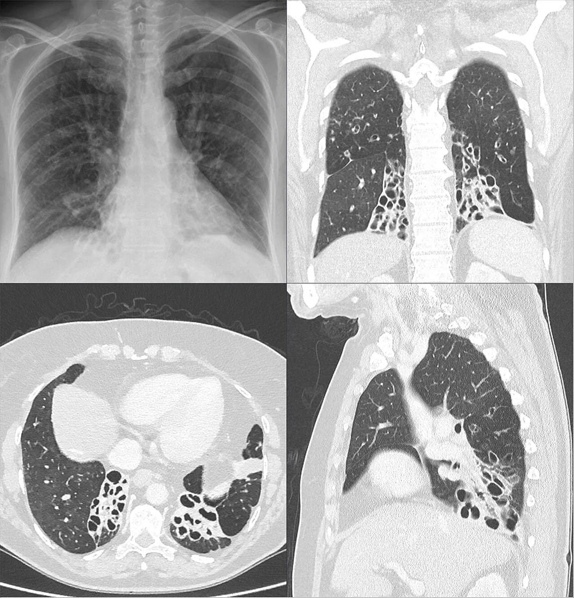 Bronchiectasis – X-ray and CT: marked cylindrical to cystic bronchiectasis in both lower lobes with thickened bronchial walls