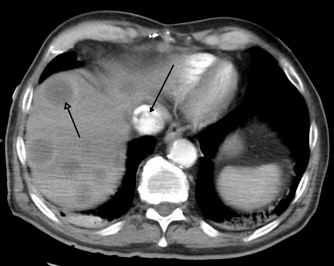Budd-Chiari syndrome – Contrast-enhanced CT: thrombus in the inferior vena cava (central arrow) with liver metastases (arrow on the left of the image) – secondary Budd-Chiari syndrome