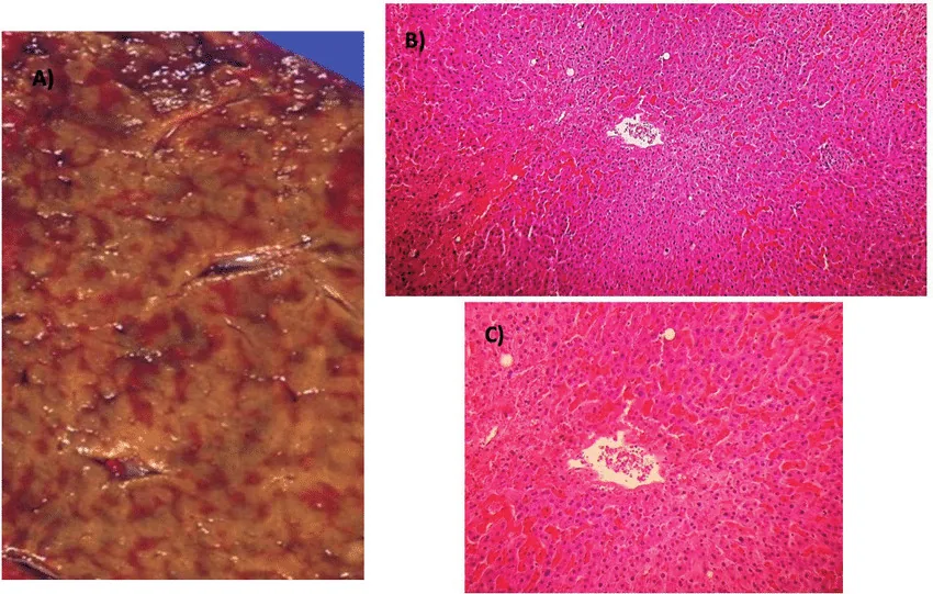 Budd-Chiari syndrome – gross specimen: Nutmeg liver: centrilobular congestion (gross and histology) due to impaired venous outflow – here cardiac, the same pattern as in Budd-Chiari syndrome