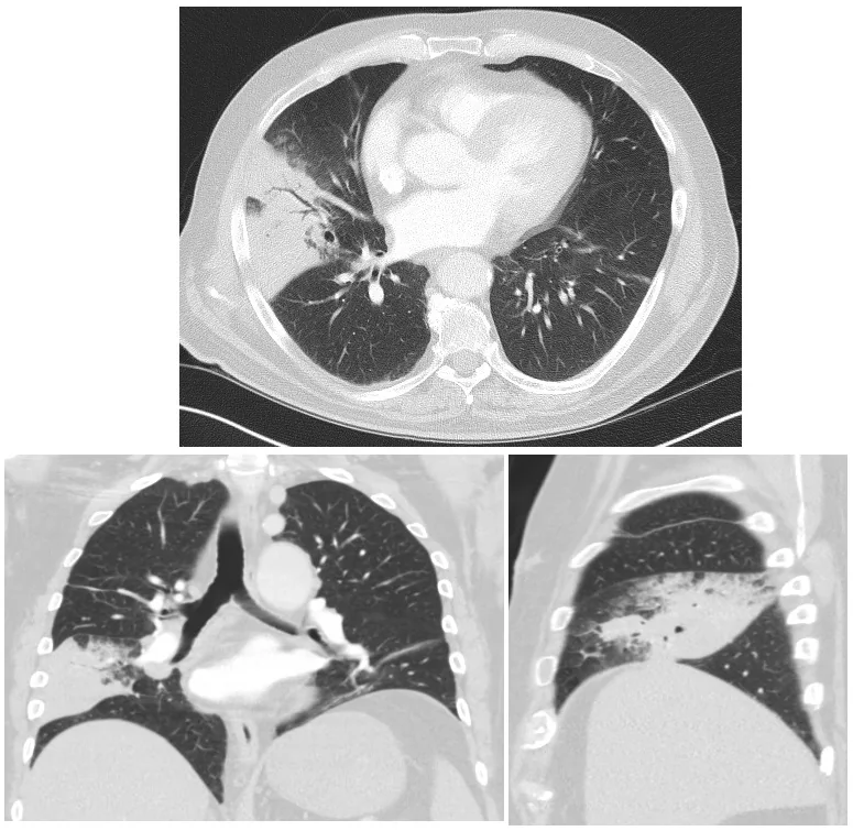 Ambulant erworbene Pneumonie (Lungenentzündung) – CT (axial, koronar, sagittal): lappenbegrenzte Konsolidierung im rechten Mittellappen mit Aerobronchogramm