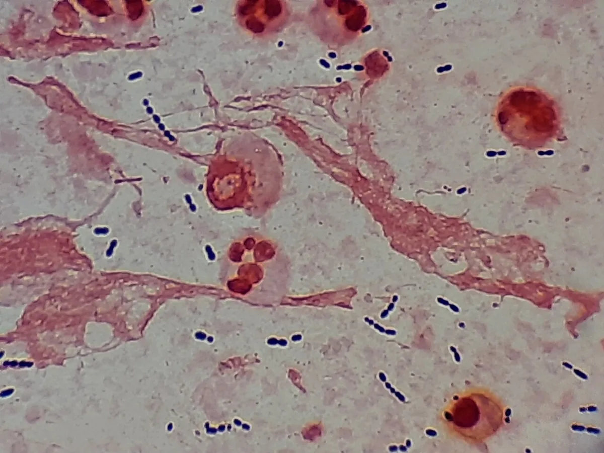 Ambulant erworbene Pneumonie (Lungenentzündung) – Blutausstrich/Zytologie: Gram-Färbung von Sputum: grampositive Kokken, teils als Diplokokken und kurze Ketten, neben neutrophilen Granulozyten