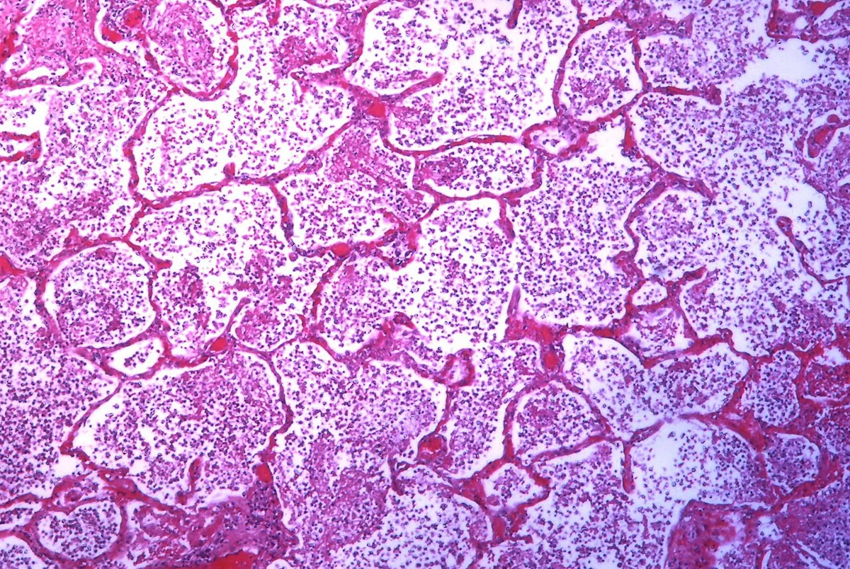 Ambulant erworbene Pneumonie (Lungenentzündung) – Histologie (HE): akute Lobärpneumonie – Alveolen dicht ausgefüllt mit neutrophilem, fibrinreichem Exsudat, Alveolarsepten erhalten