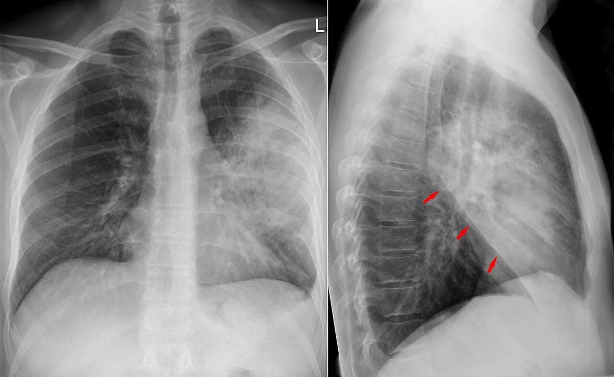 Ambulant erworbene Pneumonie (Lungenentzündung) – Röntgen-Thorax in zwei Ebenen: Lobärpneumonie im linken Oberlappen; im Seitbild markieren Pfeile die scharfe Grenze zum Unterlappen