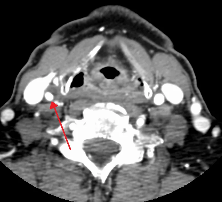 Carotid artery stenosis – CT angiography of the neck (axial): narrowed lumen of the right internal carotid artery (arrow)