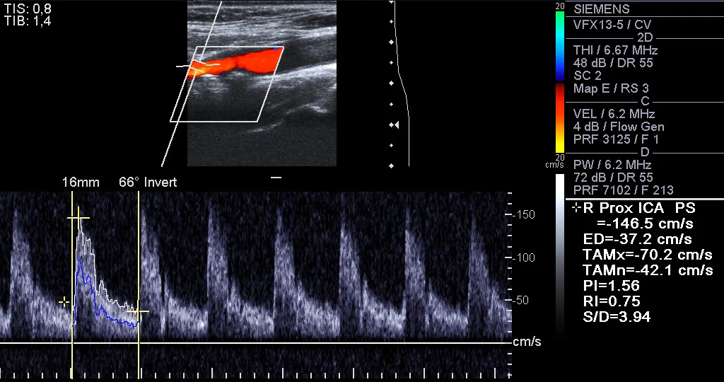 Carotid artery stenosis – Duplex ultrasound of the proximal right internal carotid artery: accelerated flow with a peak systolic velocity of about 147 cm/s