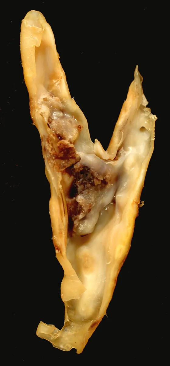 Carotid artery stenosis – gross specimen: Specimen of the carotid bifurcation: atherosclerotic plaque with calcification and hemorrhage at the origin of the internal carotid artery