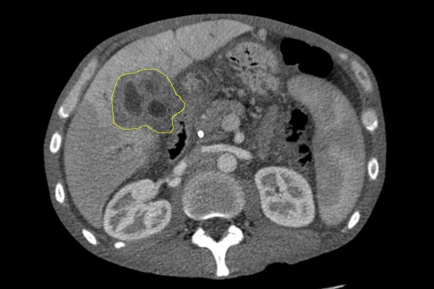 Cholangiocarcinoma (bile duct cancer) – Contrast-enhanced CT: hypodense, ill-defined mass in the right liver lobe (outlined) in cholangiocarcinoma
