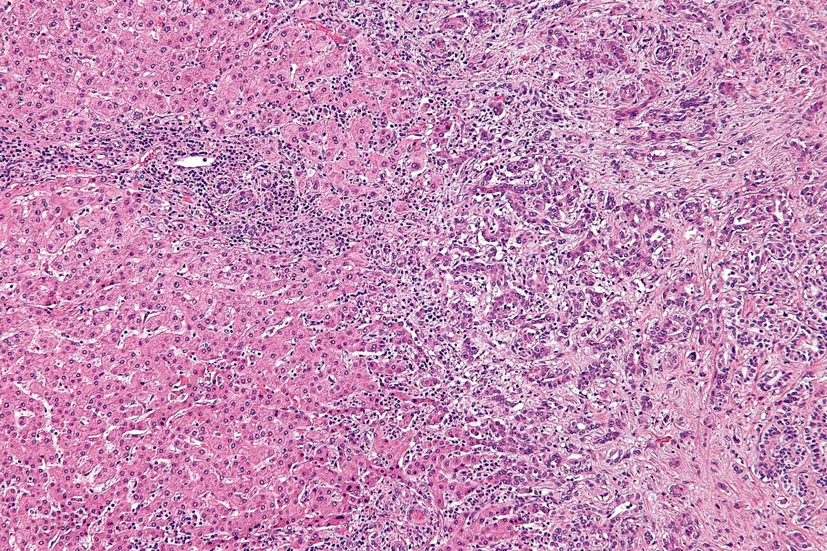 Cholangiocarcinoma (bile duct cancer) – Histology (H&E): gland-forming bile duct adenocarcinoma in desmoplastic stroma next to liver parenchyma