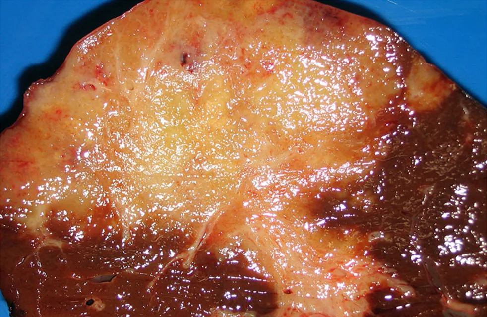Cholangiocarcinoma (bile duct cancer) – gross specimen: Cut surface of the liver: grey-white, firm tumor with stellate extensions in cholangiocarcinoma