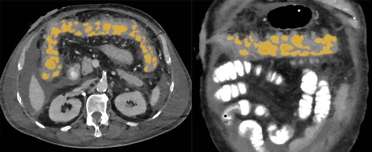 Clostridioides difficile infection – CT axial and coronal: markedly thickened, edematous colonic wall (highlighted) with polypoid bulges in Clostridioides colitis