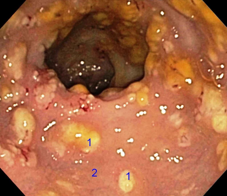 Clostridioides difficile infection – Colonoscopy: yellow-white raised pseudomembranes (1) on reddened mucosa (2) in pseudomembranous colitis