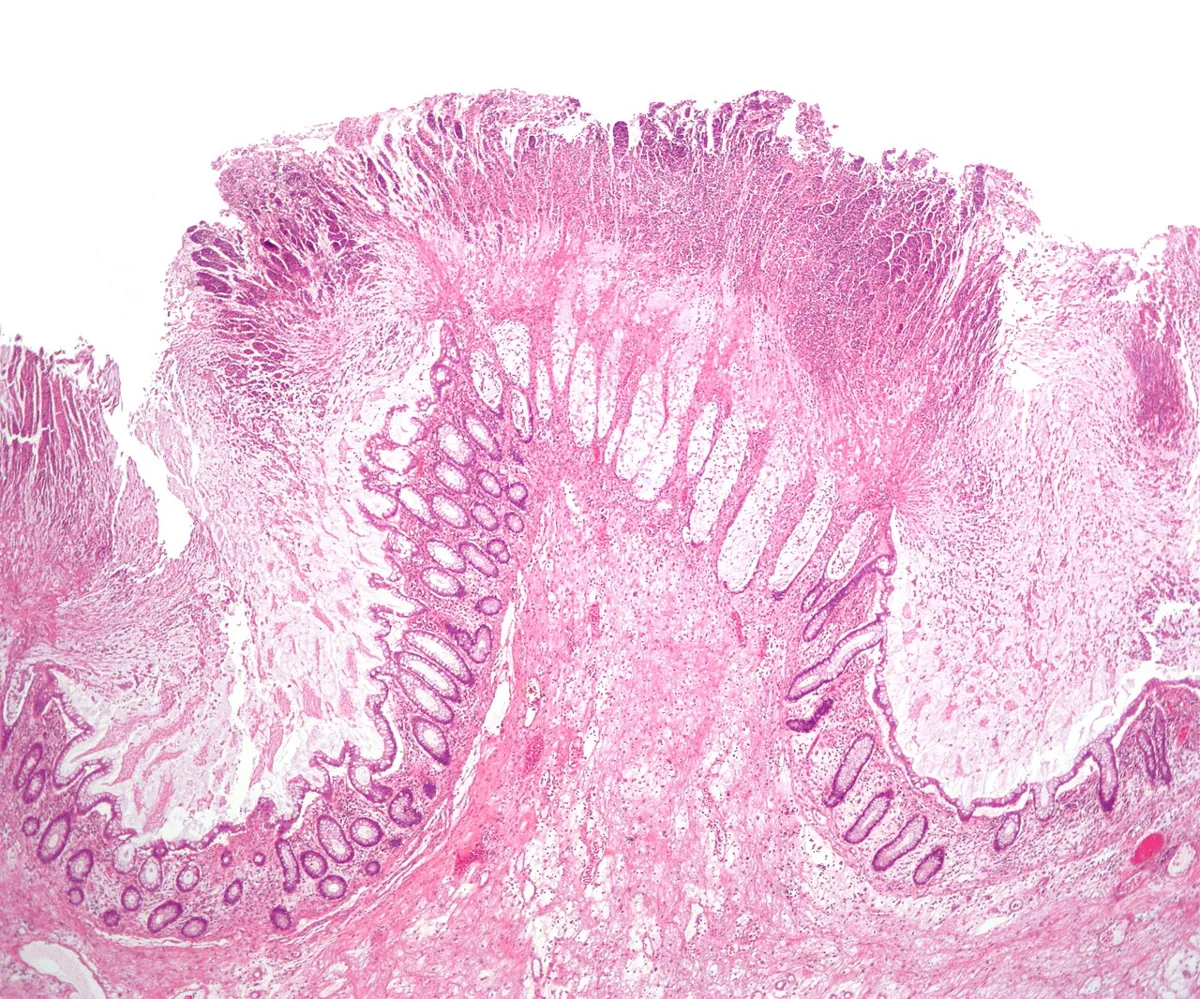 Clostridioides difficile infection – Histology (H&E, low power): volcano-like pseudomembranes of fibrin, mucus and neutrophils erupting from the crypts
