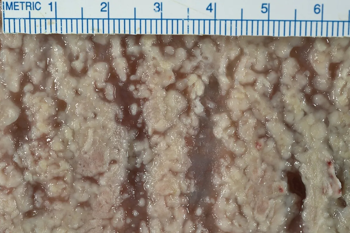 Clostridioides difficile infection – gross specimen: En face view of the colonic mucosa: densely packed yellow-white pseudomembranes in pseudomembranous colitis