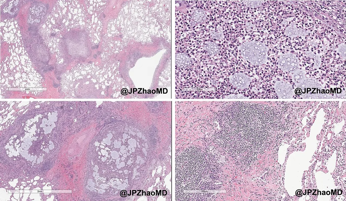 Mukoviszidose (zystische Fibrose) – Histologie (HE) bei zystischer Fibrose: Atemwege mit Schleim und eitrigem Exsudat, akute und chronische Entzündung sowie peribronchioläre Fibrose