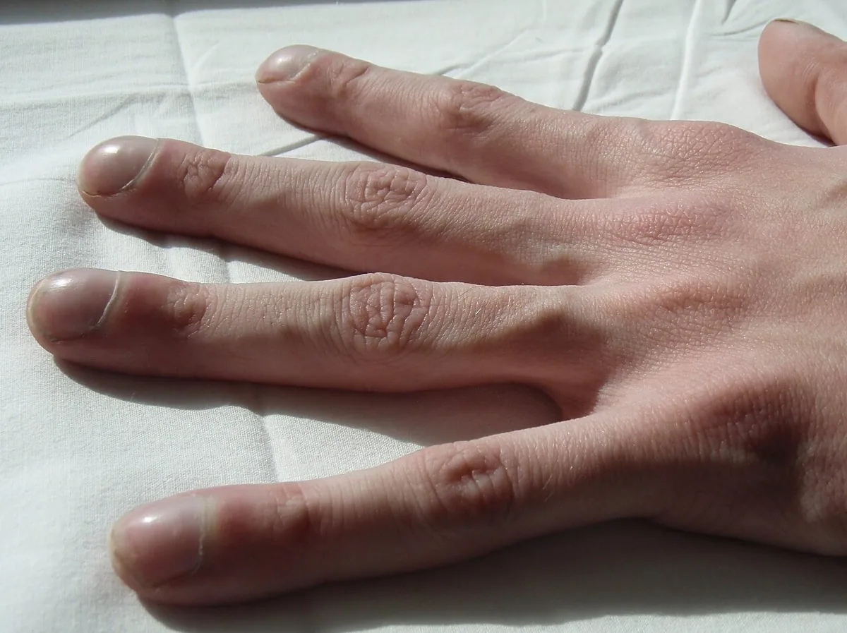 Mukoviszidose (zystische Fibrose) – Nagel – klinisches Foto: Trommelschlägelfinger mit verbreiterten Fingerendgliedern und gewölbten Nägeln bei zystischer Fibrose