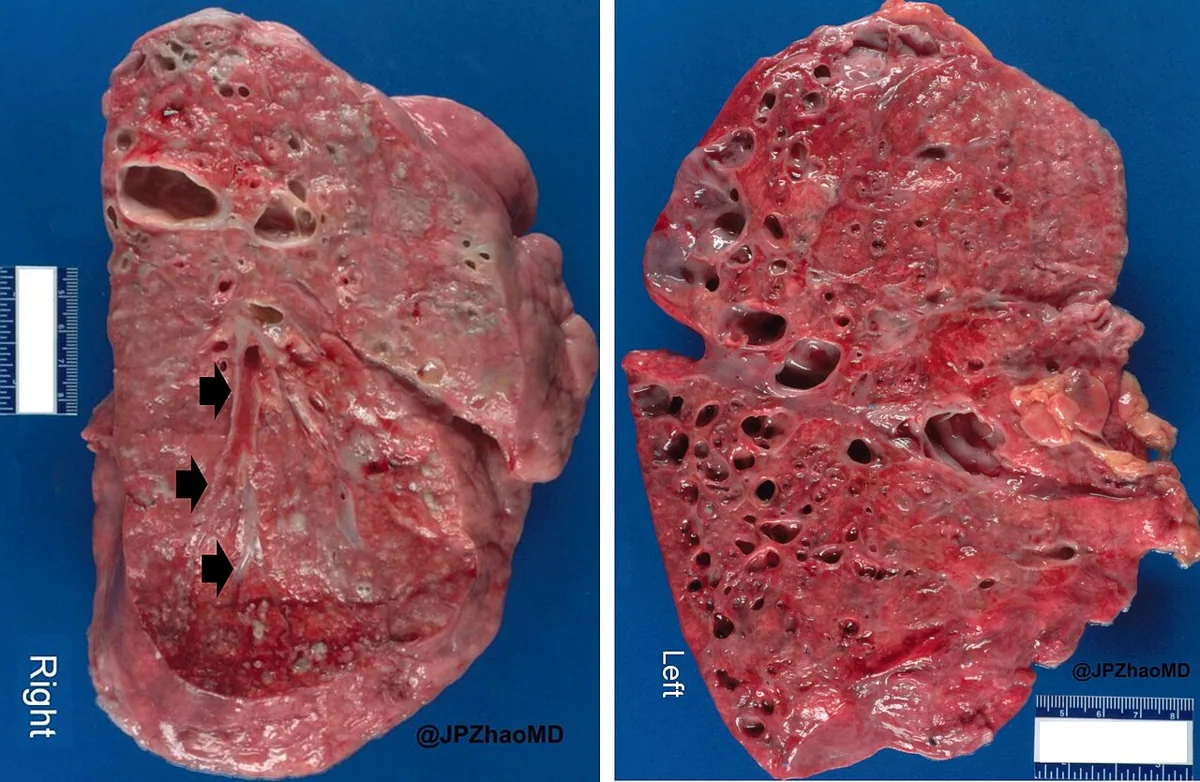 Mukoviszidose (zystische Fibrose) – Makropräparat: Schnittfläche der Lunge bei zystischer Fibrose: beidseits erweiterte Bronchien, teils mit zähem Sekret gefüllt (Pfeile), diffuse Bronchiektasen