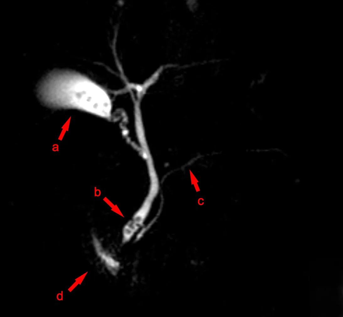 Choledocholithiasis and acute cholangitis – MRI scan: MRCP: stones as round filling defects in the gallbladder (a) and the distal common bile duct (b); c pancreatic duct, d duodenum