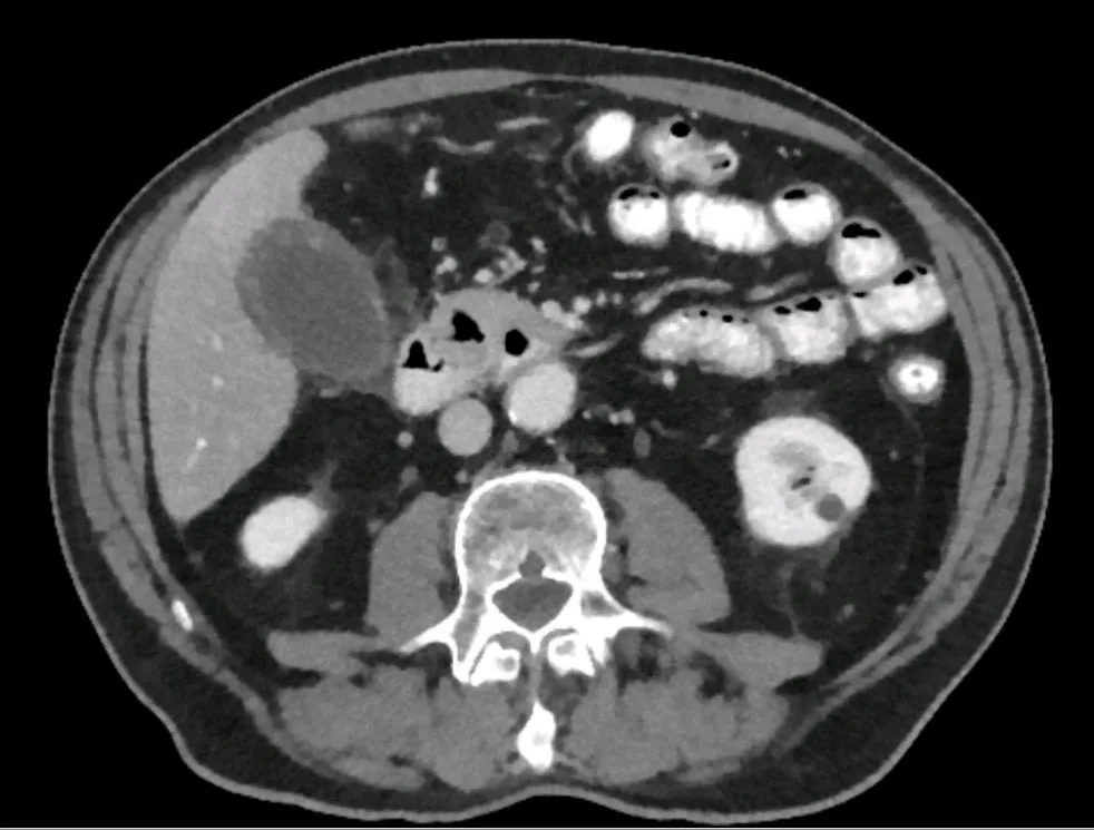 Cholezystolithiasis und akute Cholezystitis (Gallensteine) – CT mit Kontrastmittel: akute Cholezystitis mit verdickter, ödematöser Gallenblasenwand und entzündlich verdichtetem Umgebungsfett