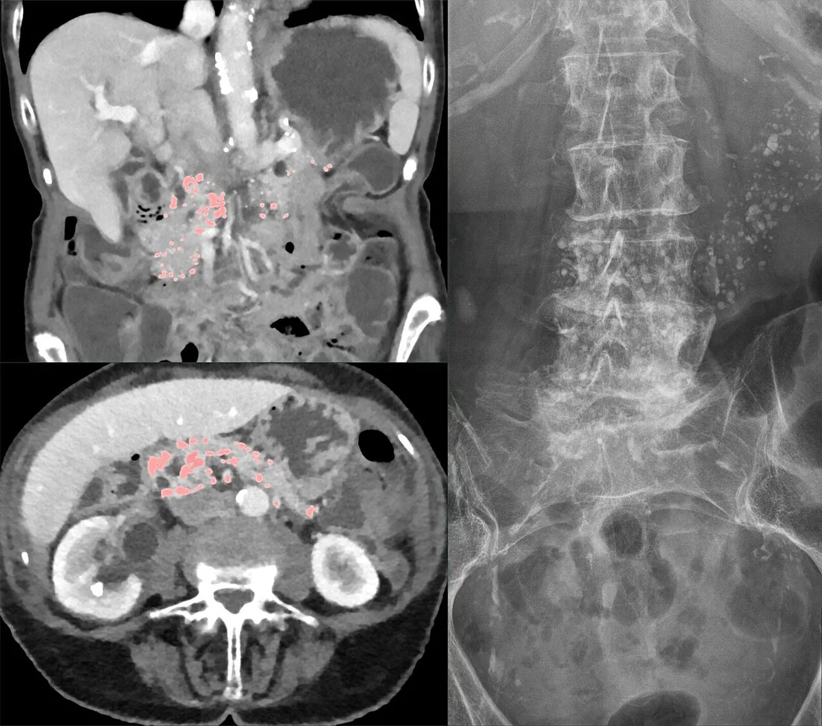 Chronic pancreatitis – CT coronal and axial (left) and abdominal X-ray (right): multiple pancreatic calcifications in chronic pancreatitis
