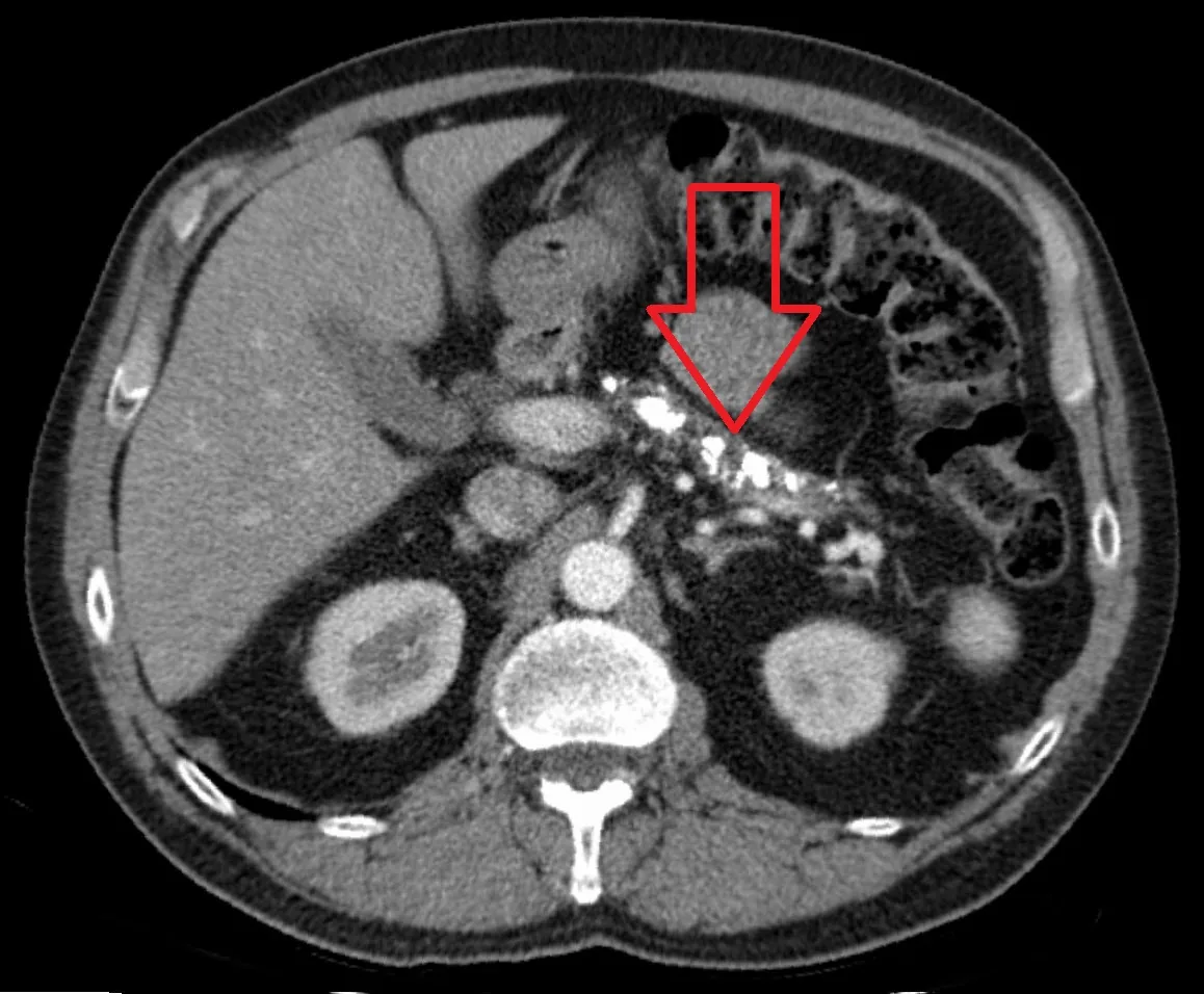 Chronic pancreatitis – Axial CT: numerous coarse calcifications in the atrophic pancreas (arrow) in chronic pancreatitis