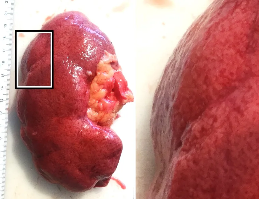 Chronic kidney disease – Gross specimen of a kidney with nephrosclerosis: finely granular surface (detail magnified on the right)