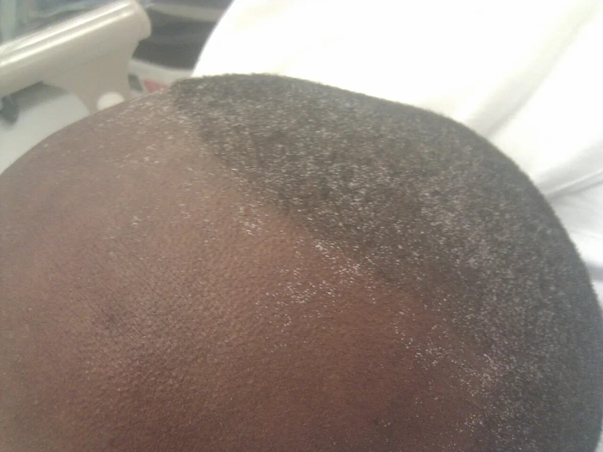 Chronic kidney disease – face – clinical photo: Uremic frost: fine whitish urea crystal deposits on the forehead and scalp in advanced uremia