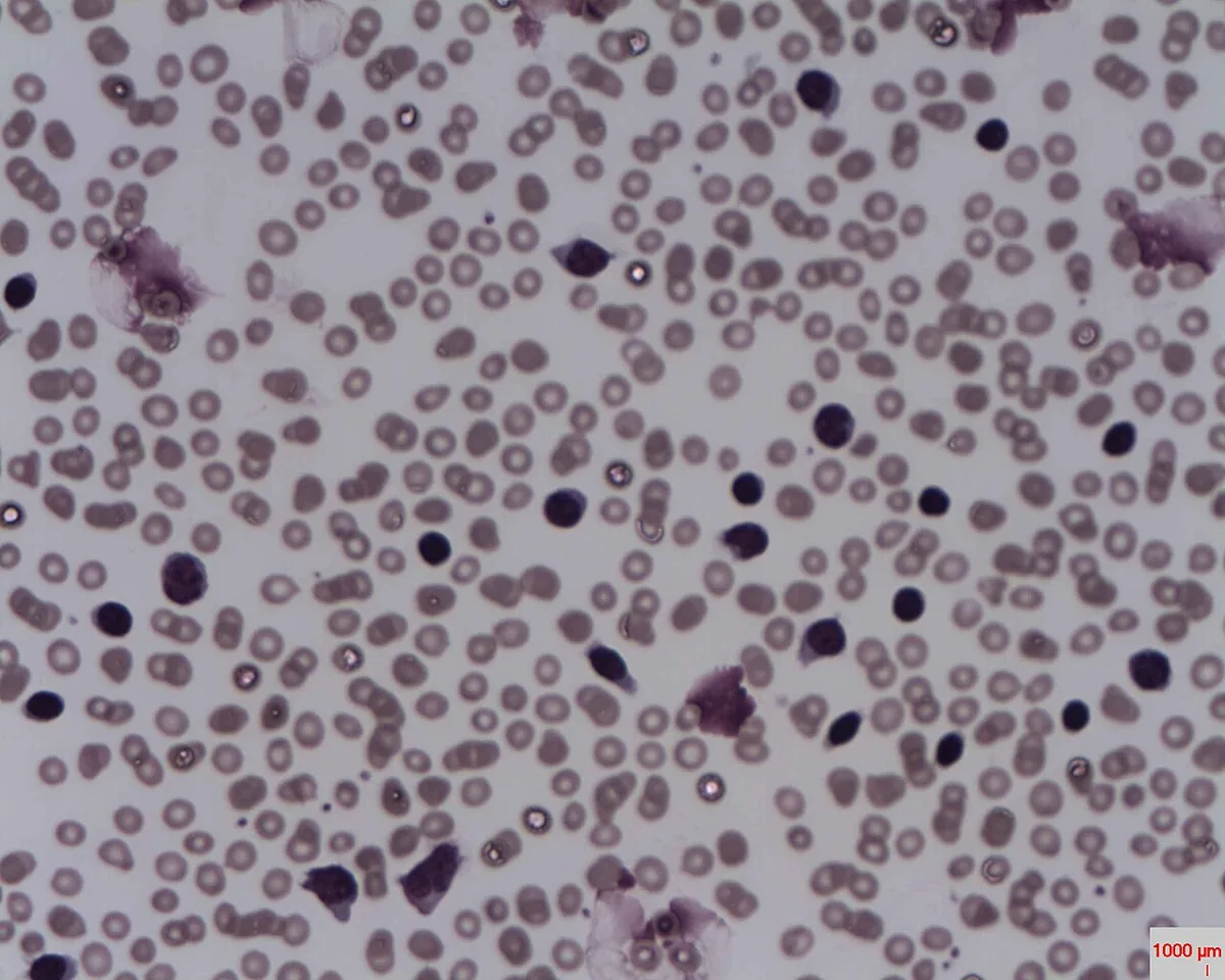 Chronic lymphocytic leukemia (CLL) – Blood smear in CLL: marked lymphocytosis with small mature lymphocytes and smudge cells