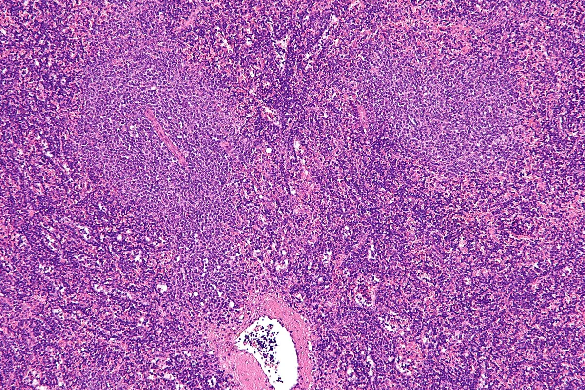 Chronic lymphocytic leukemia (CLL) – Lymph node histology in CLL/small lymphocytic lymphoma: diffuse infiltrate of small lymphocytes with paler proliferation centers