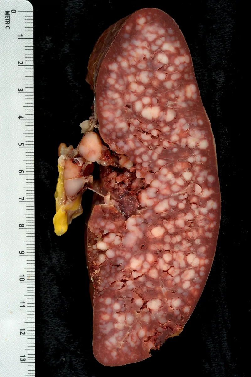 Chronic lymphocytic leukemia (CLL) – gross specimen: Cut surface of an enlarged spleen in CLL: numerous whitish nodules of lymphoma infiltrate, enlarged hilar lymph nodes