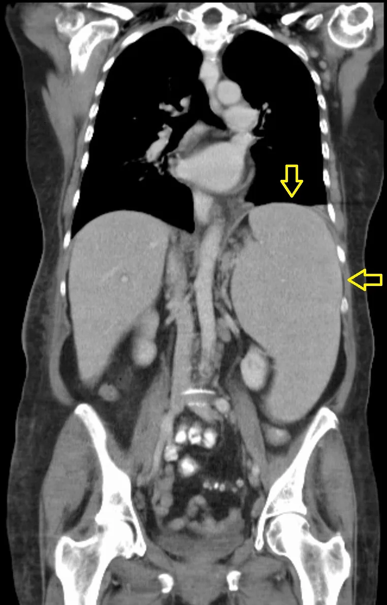 Chronic lymphocytic leukemia (CLL) – Coronal CT in CLL: markedly enlarged spleen (arrows) in the left upper abdomen