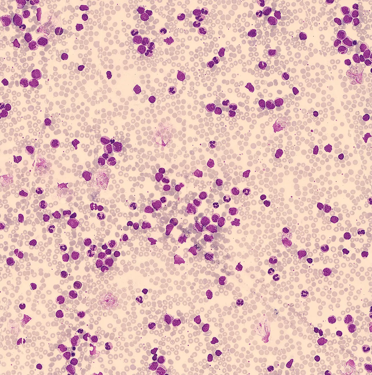 Chronic myeloid leukemia (CML) – Peripheral blood smear in CML (overview): massively increased leukocytes of the granulocytic series