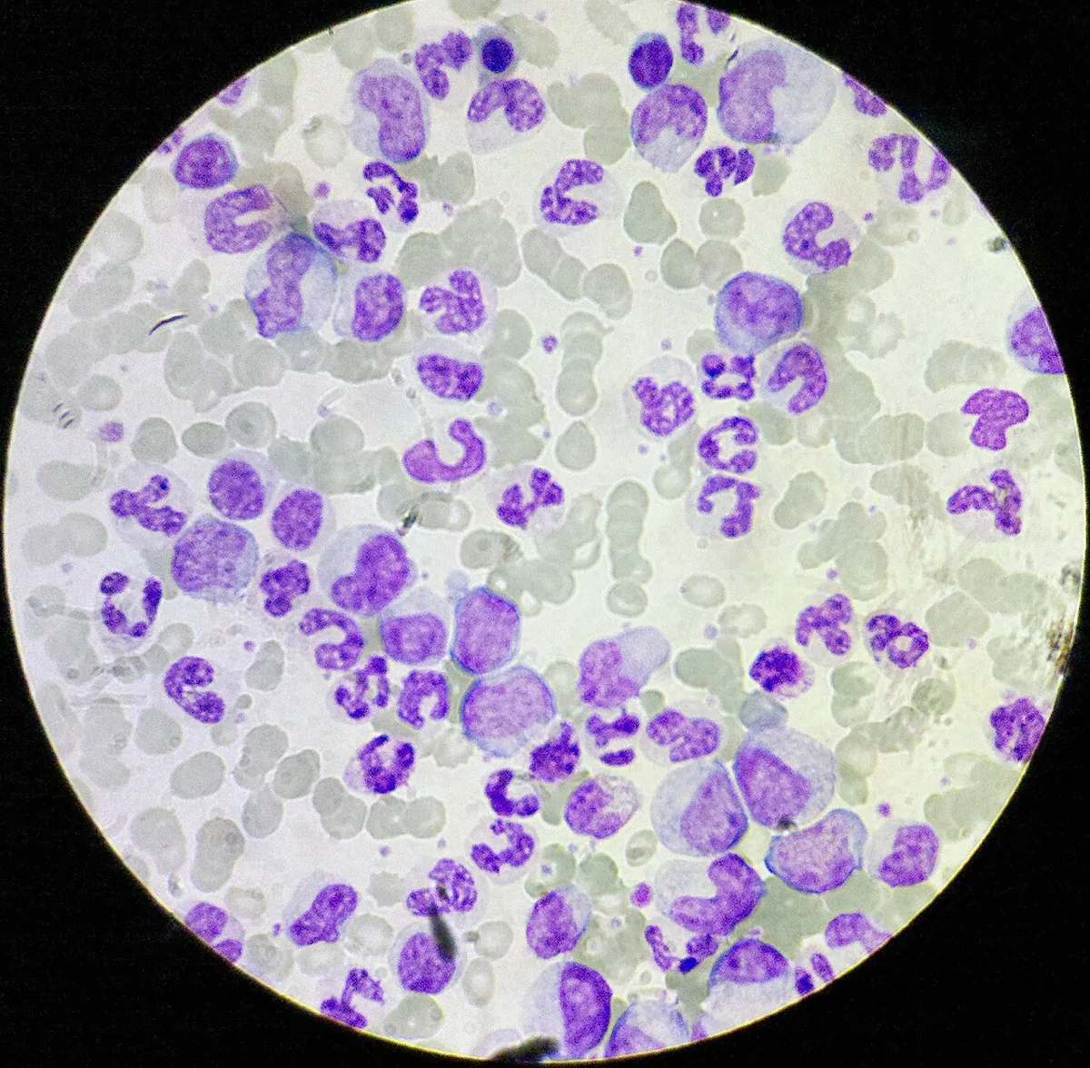 Chronic myeloid leukemia (CML) – Blood smear in CML: myelocytes, metamyelocytes, band and segmented neutrophils crowded together