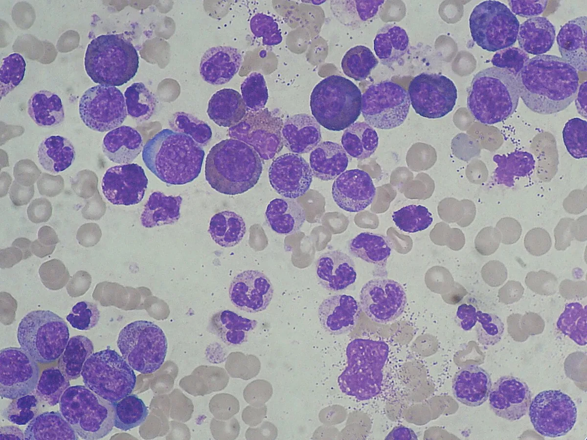 Chronic myeloid leukemia (CML) – Blood smear in CML: marked leukocytosis with all maturation stages of granulopoiesis (pathological left shift)