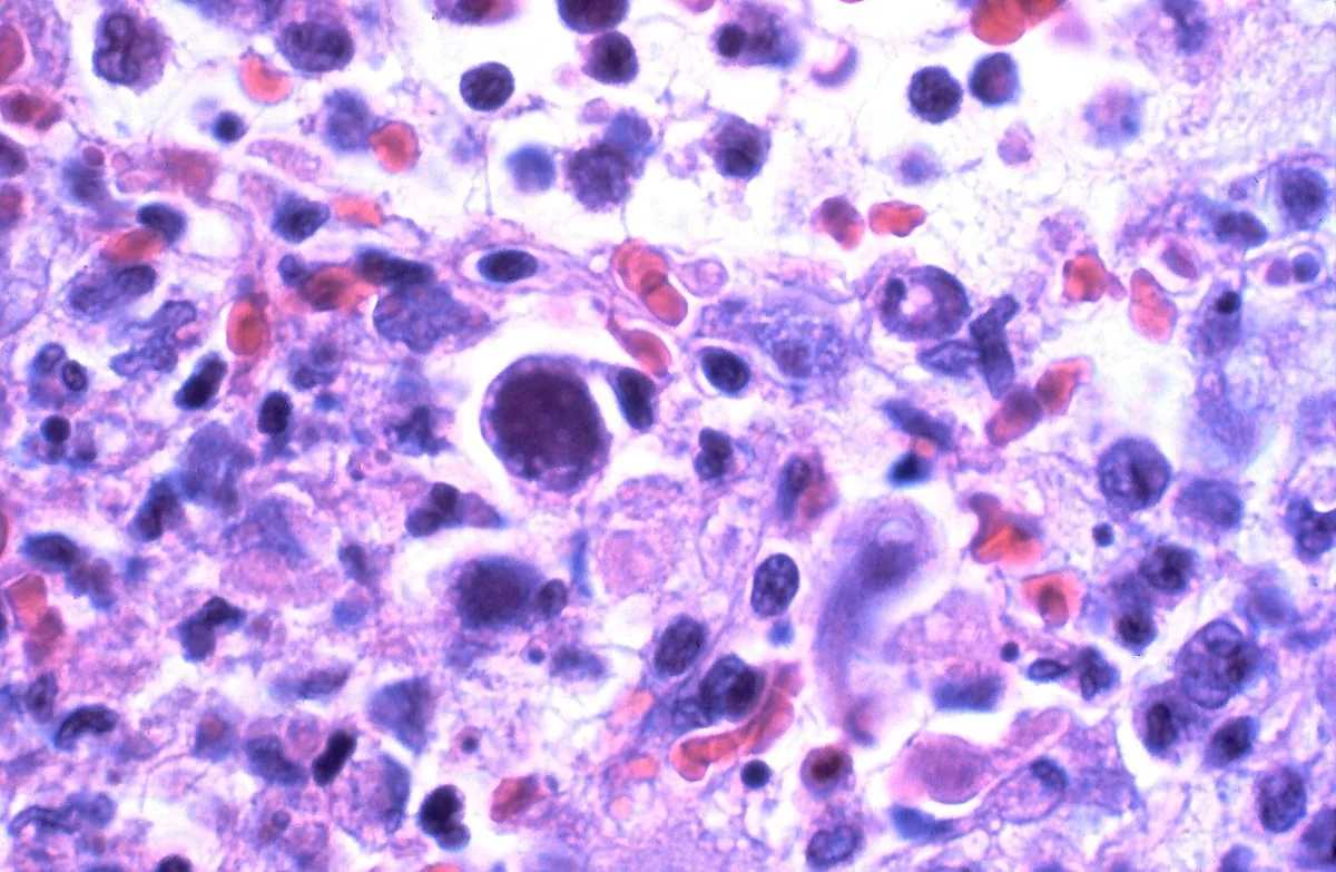 Cytomegalovirus infection (CMV) – Lung histology (H&E): enlarged cell with a large basophilic nuclear inclusion ("owl's eye" cell) in CMV infection