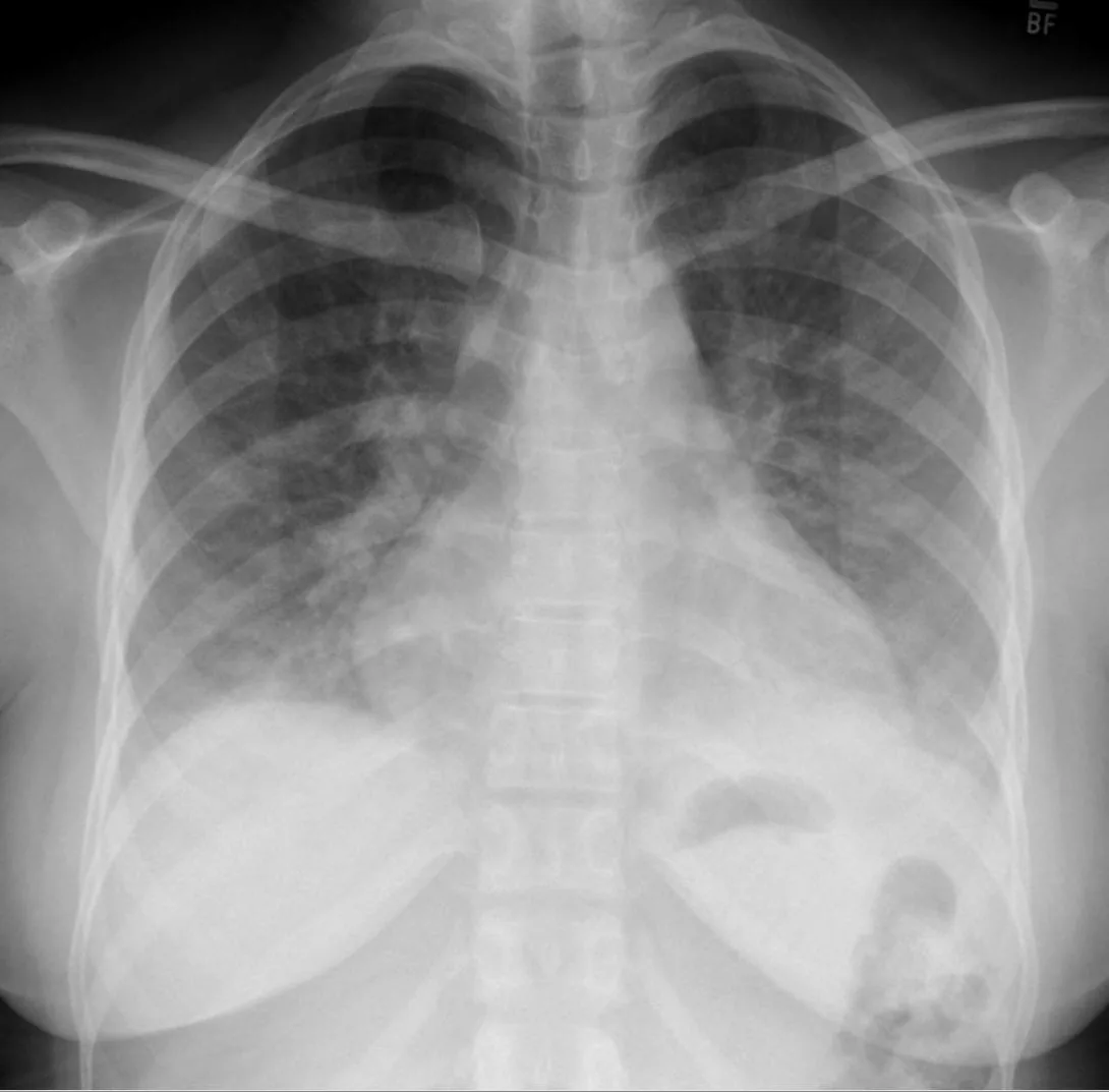 Cytomegalovirus infection (CMV) – Chest X-ray in CMV pneumonia: bilateral reticulonodular and patchy opacities, most marked in the lower zones
