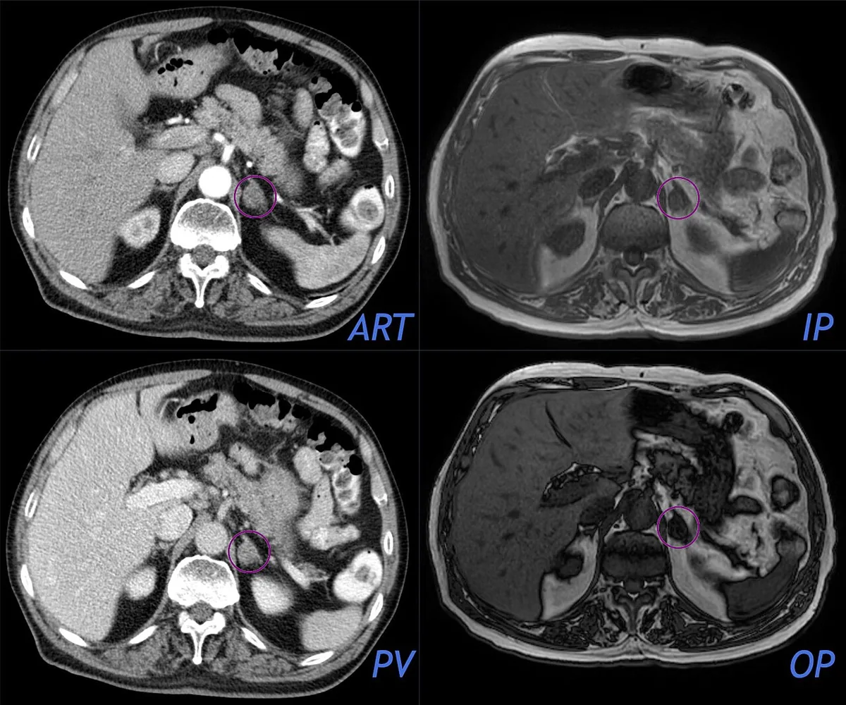 Primary aldosteronism (Conn's syndrome) – CT (arterial/portal venous) and MRI (in/opposed phase): small, smooth left adrenal adenoma (marked) with signal drop on opposed phase