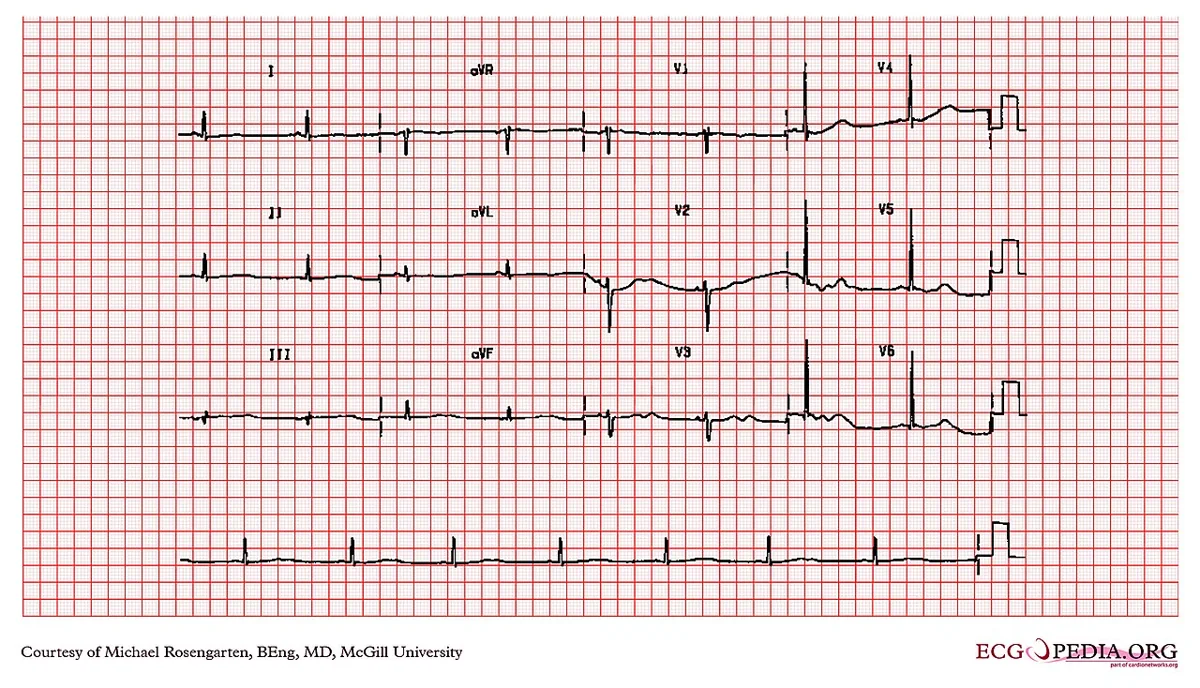 Primary aldosteronism (Conn's syndrome) – ECG pattern of hypokalemia as can occur in Conn's syndrome: flat T waves, prominent U waves and slight ST depression
