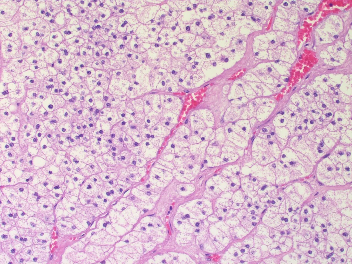 Primary aldosteronism (Conn's syndrome) – Histology of an adrenocortical adenoma (H&E): nests and cords of lipid-rich cells with clear, foamy cytoplasm