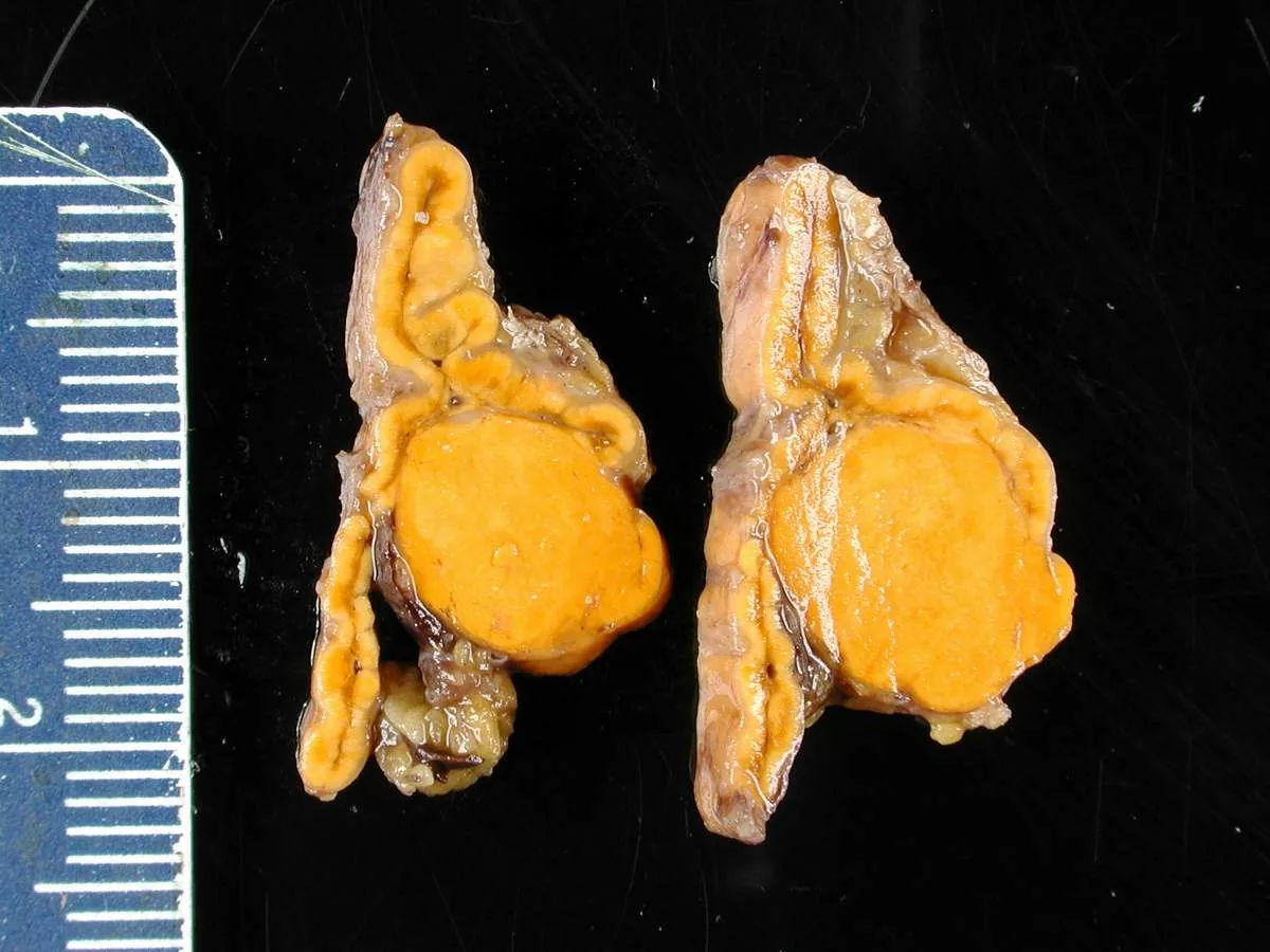 Primary aldosteronism (Conn's syndrome) – gross specimen: Adrenal gland in Conn's syndrome, cut surface: well-circumscribed, golden-yellow cortical adenoma