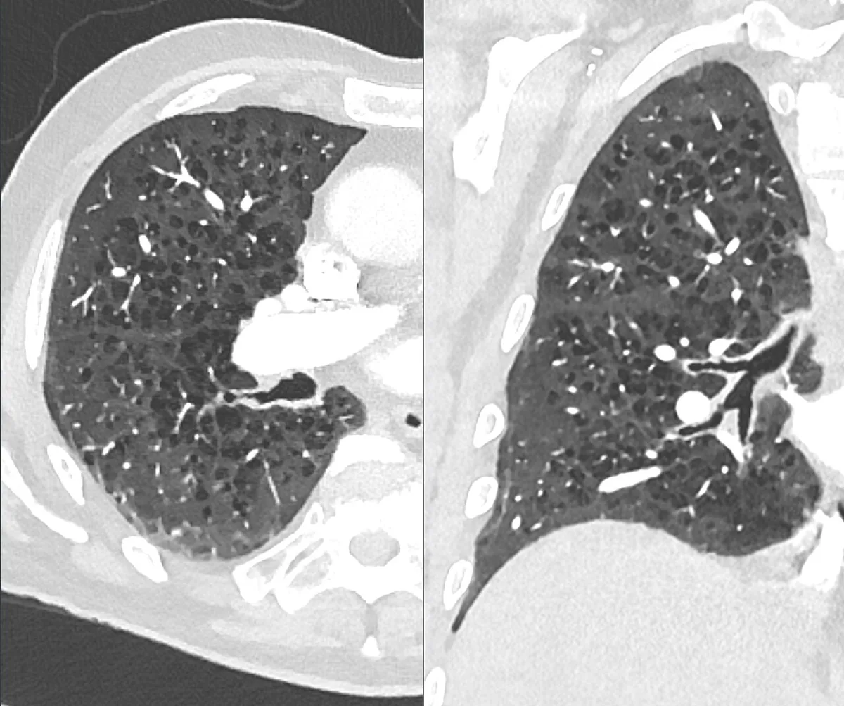 COPD (chronic obstructive pulmonary disease) – CT (axial and coronal): centrilobular emphysema with numerous small wall-less lucencies around the bronchovascular bundles