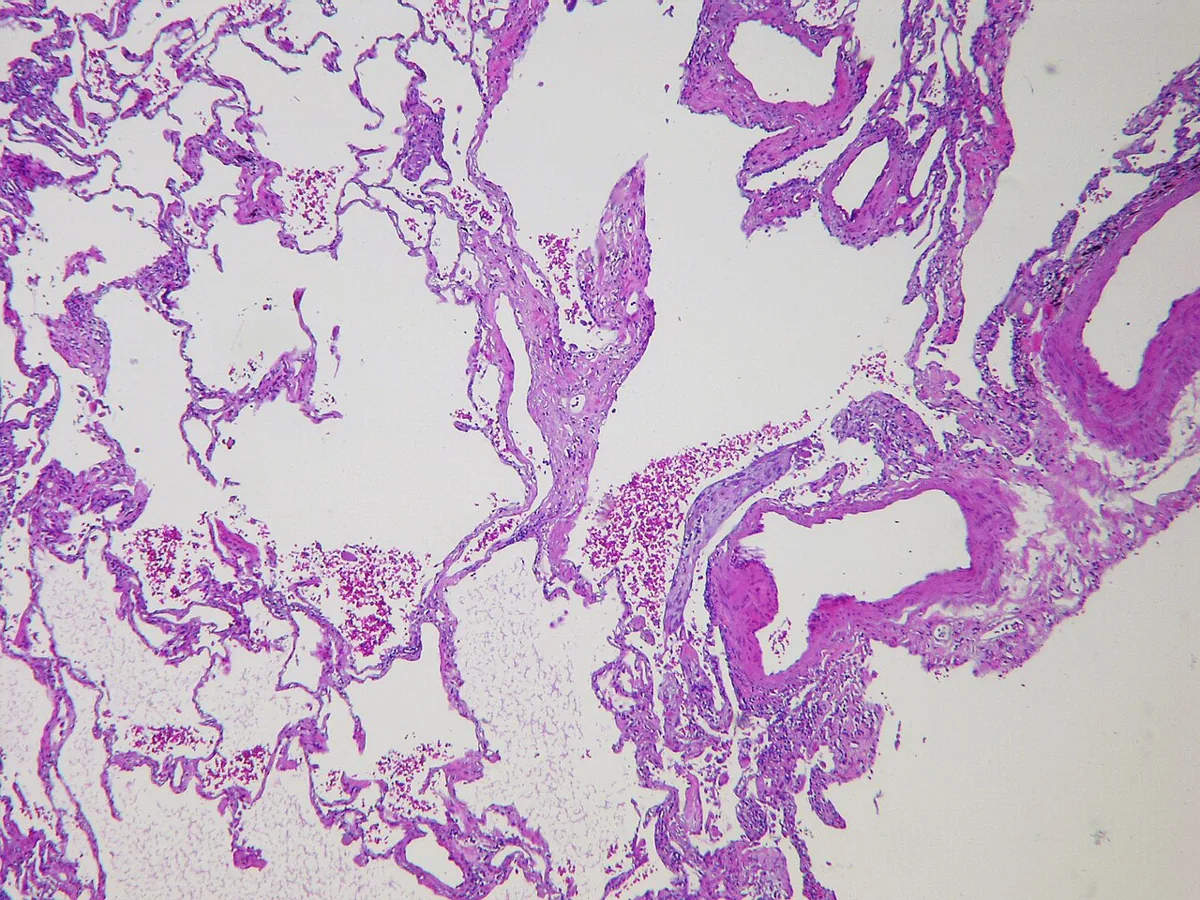 COPD (chronic obstructive pulmonary disease) – Histology (H&E): centrilobular emphysema with destruction of alveolar walls and enlarged airspaces