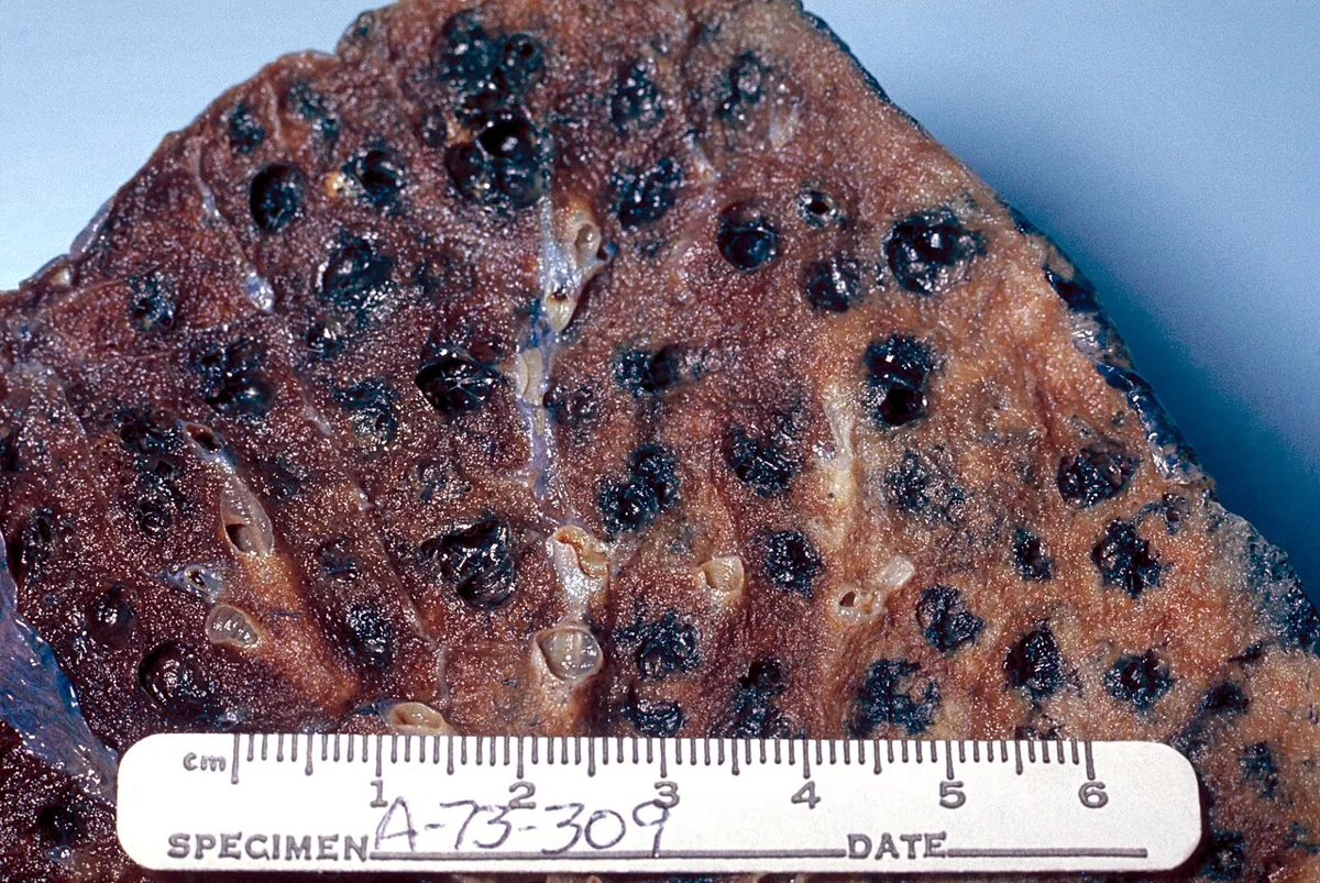 COPD (chronic obstructive pulmonary disease) – Gross specimen: centrilobular emphysema with numerous small cavities lined by black carbon deposits (smoker's lung)