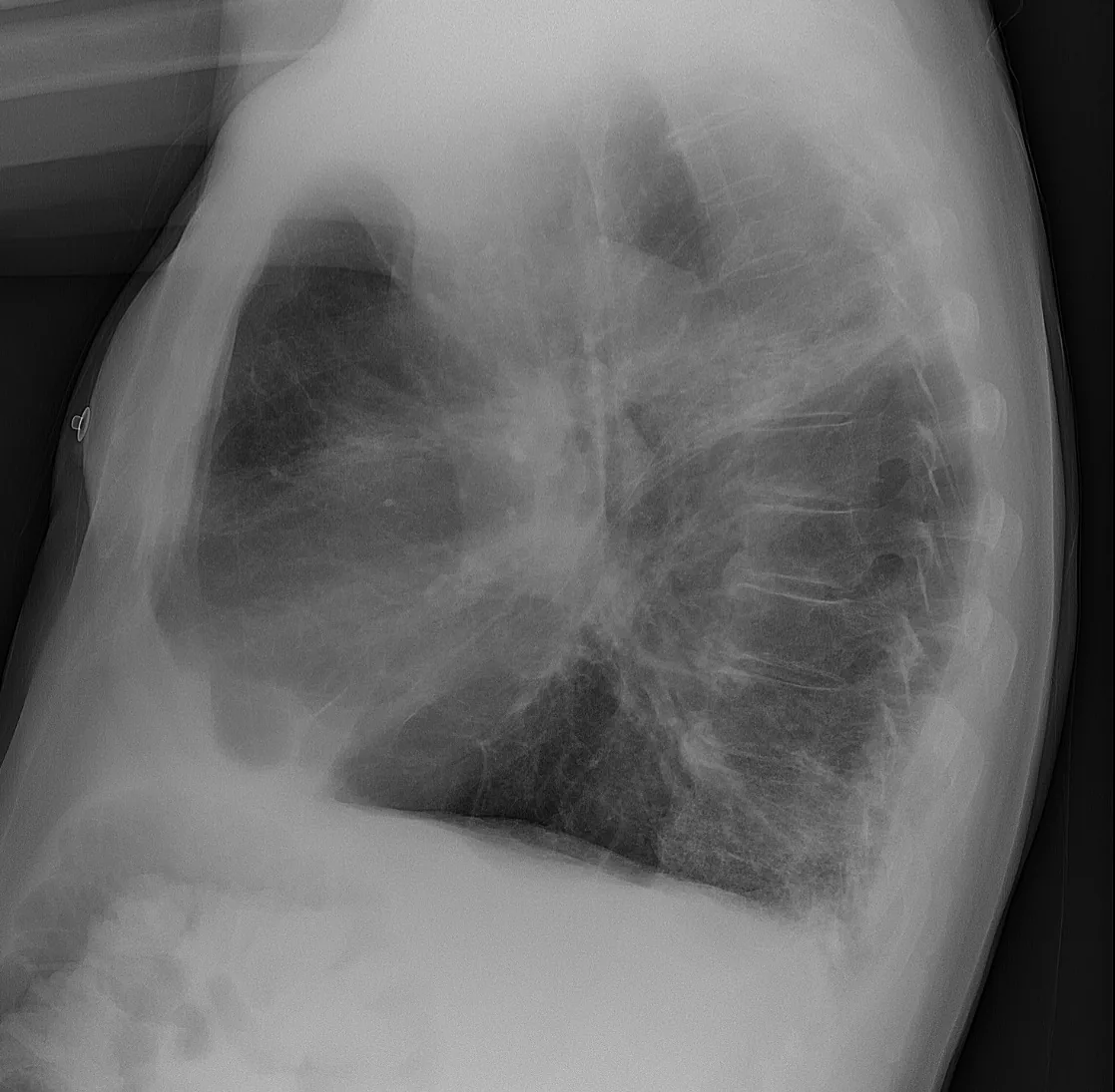 COPD (chronic obstructive pulmonary disease) – Lateral chest X-ray: enlarged retrosternal space, barrel chest and low, flattened diaphragms