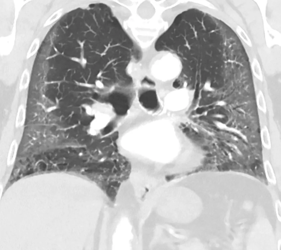 COVID-19 – CT in COVID-19 pneumonia (coronal): bilateral peripheral ground-glass opacities, most marked in the lower zones