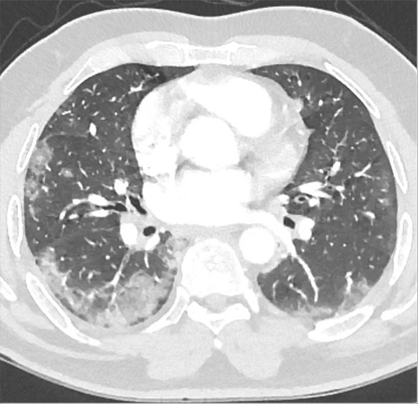 COVID-19 – CT in COVID-19 pneumonia (axial): bilateral, subpleural ground-glass opacities and consolidations