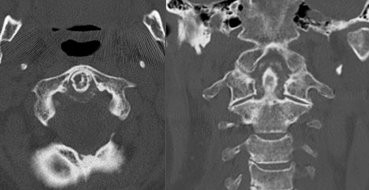 CPPD disease (pseudogout, chondrocalcinosis) – CT of the upper cervical spine (axial/coronal): crown-like calcifications around the dens (crowned dens syndrome)