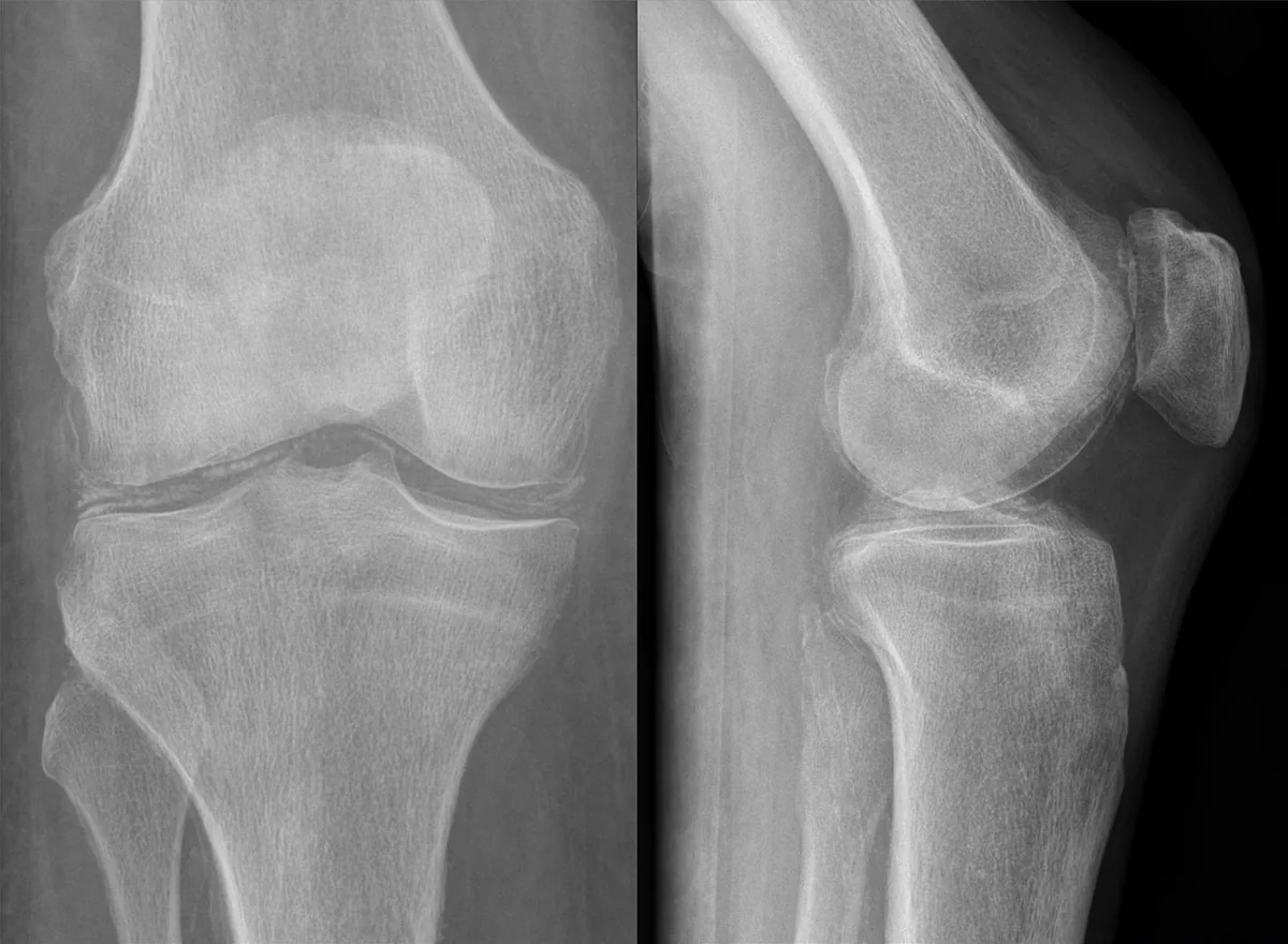 CPPD disease (pseudogout, chondrocalcinosis) – Knee X-ray in 2 planes: linear calcifications in the menisci and articular cartilage (chondrocalcinosis)
