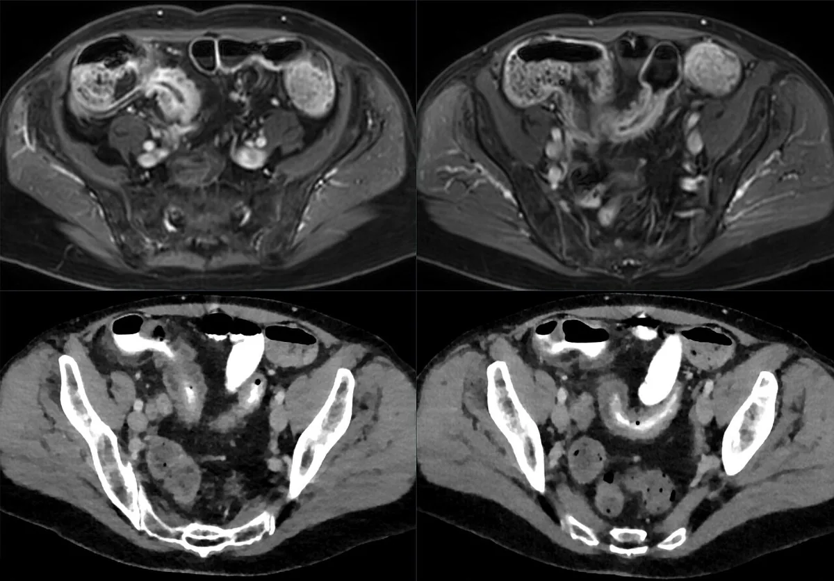 Crohn's disease – CT scan: Terminal ileitis: top MRI (contrast T1), bottom CT – thickened, enhancing ileal wall in the right lower abdomen