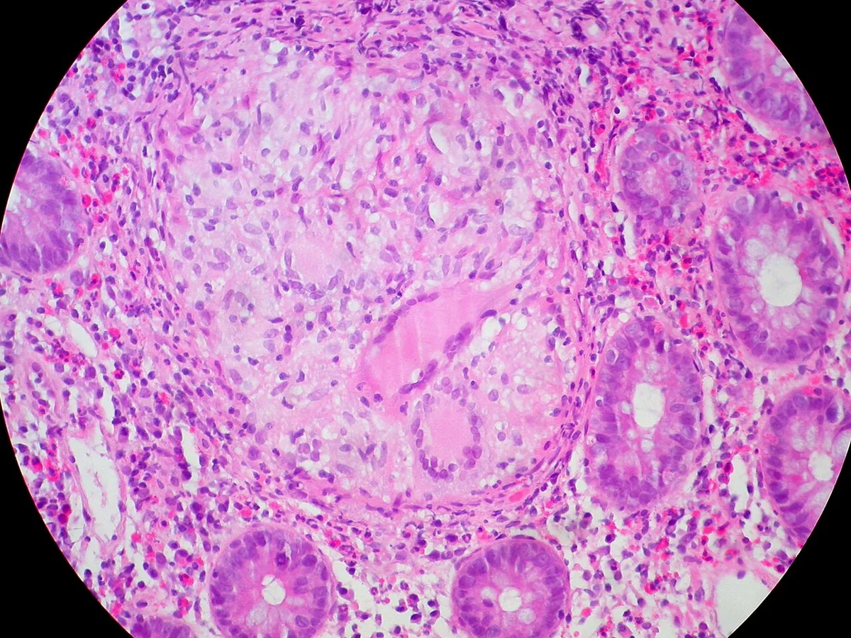 Crohn's disease – Histology (H&E): non-caseating epithelioid granuloma with a giant cell in the bowel mucosa